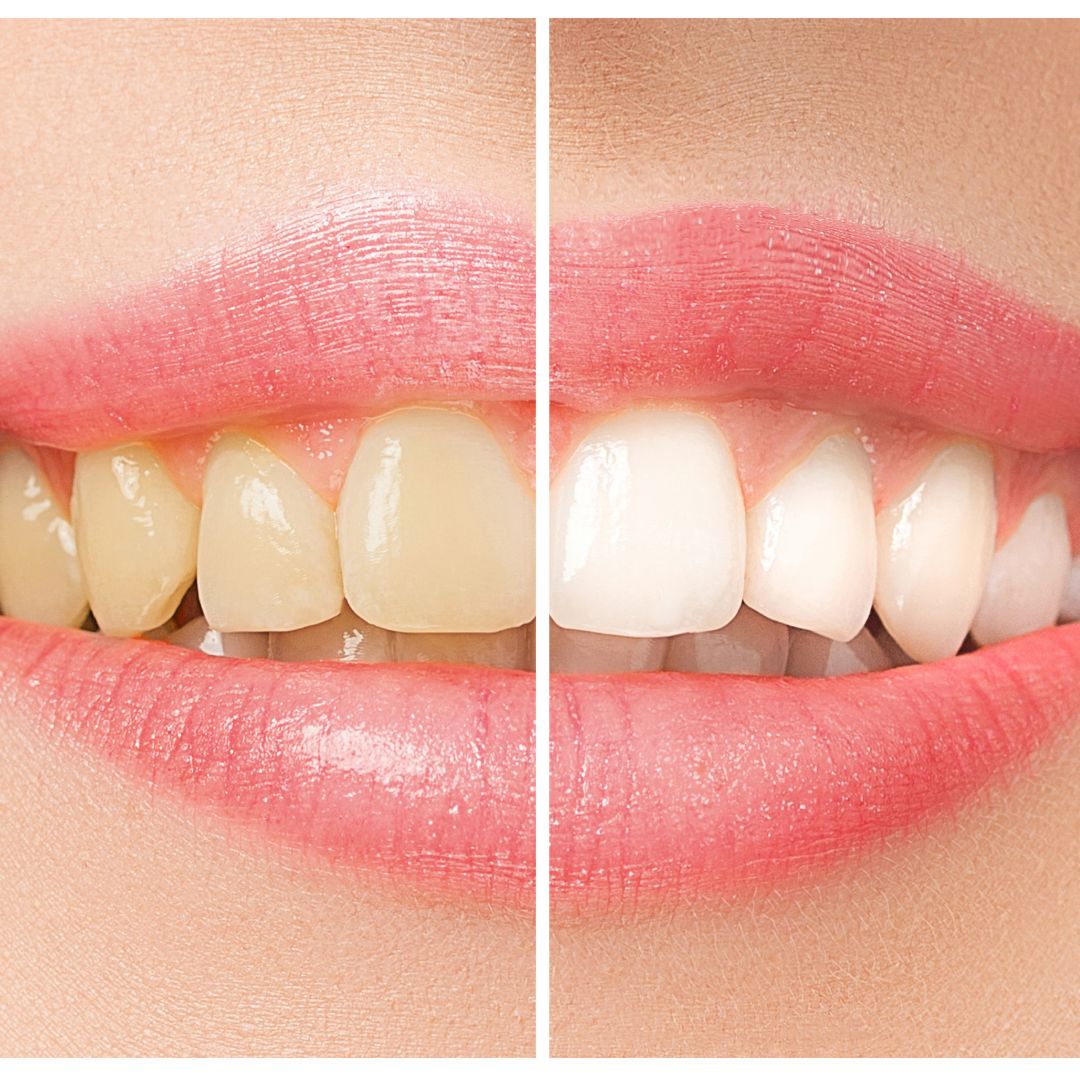 Efero GlowStick  Fast-Acting Whitening Serum for Teeth