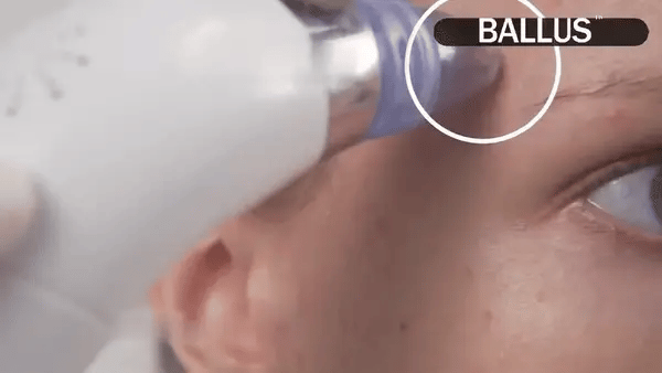 Deep Clean Pore Vacuum Rechargeable Blackhead Remover & Skin Purifier